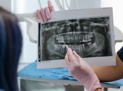 puede generar complicaciones biomecánicas como desgaste dentario, trauma periodontal, desalojo y fractura de restauraciones, prótesis fija e implantes, lo cual se puede prevenir con el uso de dispositivos interoclusales”, indica el Dr. Salinas