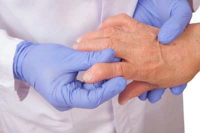La artritis reumatoidea, que afecta el revestimiento de las articulaciones, es otra de las enfermedades autoinmunes más conocidas. 