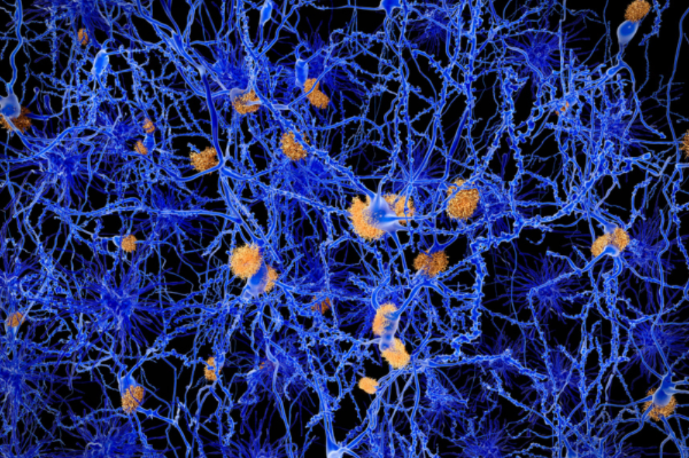 Ilustración digital de placas amiloides entre neuronas, una de las características distintivas de la enfermedad de Alzheimer, asociadas a la degeneración neuronal.
