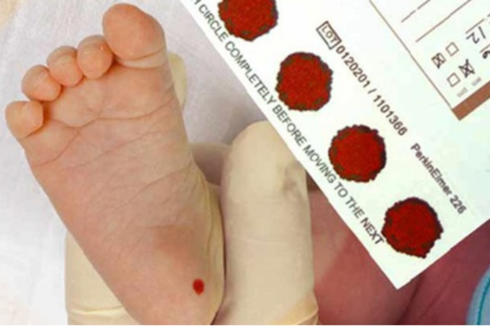 Toma de muestra de sangre desde el talón de un recién nacido, procedimiento clave en la pesquisa neonatal para la detección temprana de enfermedades metabólicas.