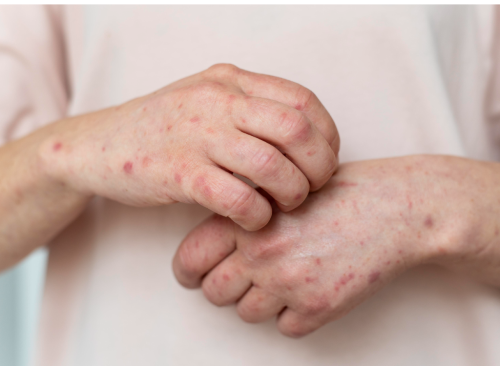 Llaman a todos los nacidos entre 1971 y 1981 a vacunarse contra el Sarampión