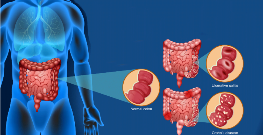 Conociendo los mecanismos moleculares de una bacteria potencialmente benéfica para colitis ulcerosa y enfermedad de Crohn