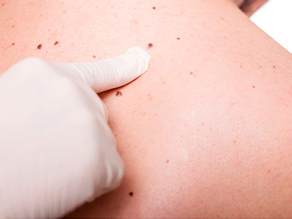 El modelo predictor desarrollado por el equipo en base a inteligencia artificial, disminuye los pasos en la detección del melanoma.