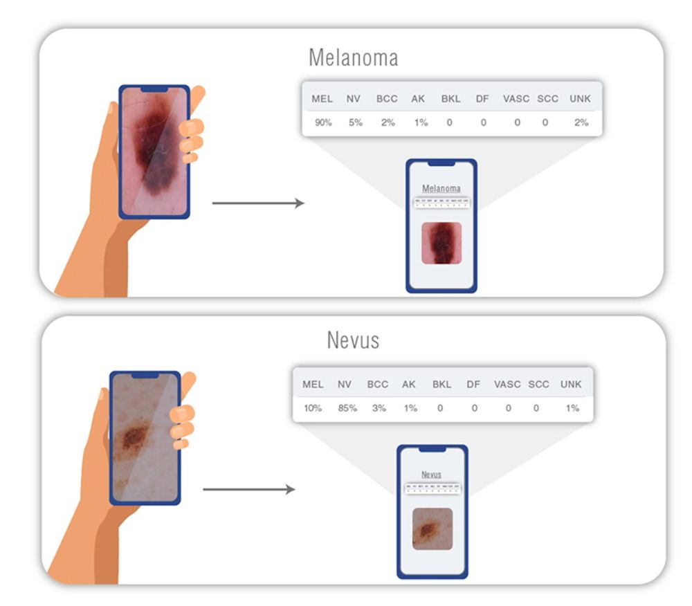 El proyecto utiliza Deep learning, en español “aprendizaje profundo”, un tipo algoritmo que utiliza redes neuronales artificiales de muchas capas, en el cual se entrena la computadora para reconocer patrones.