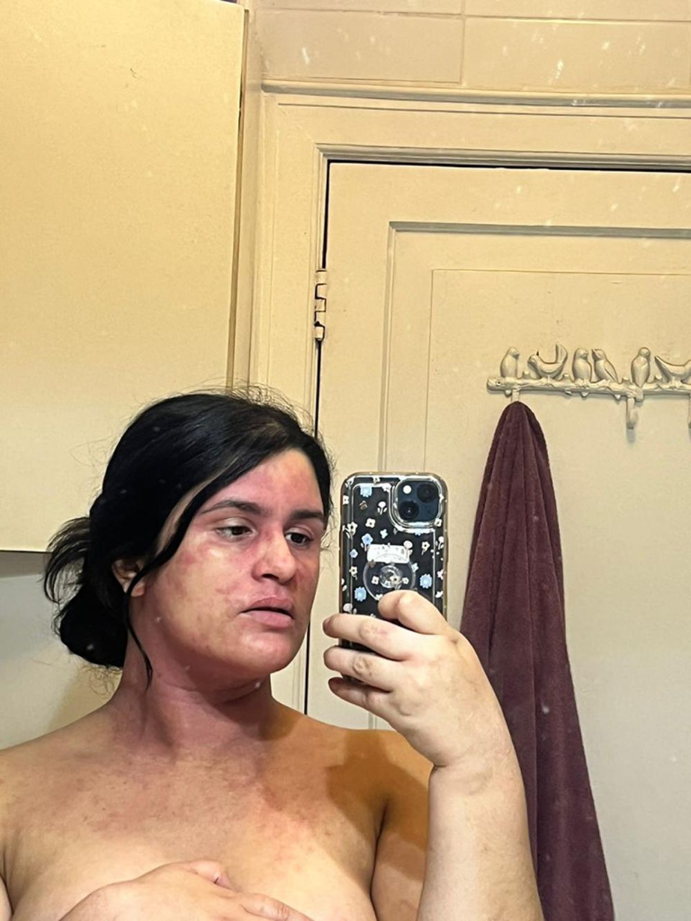 Hay distintos factores que pueden incidir en la aparición de esta patología: mutaciones genéticas, características del ambiente, y condiciones propias de la piel de dichas personas.