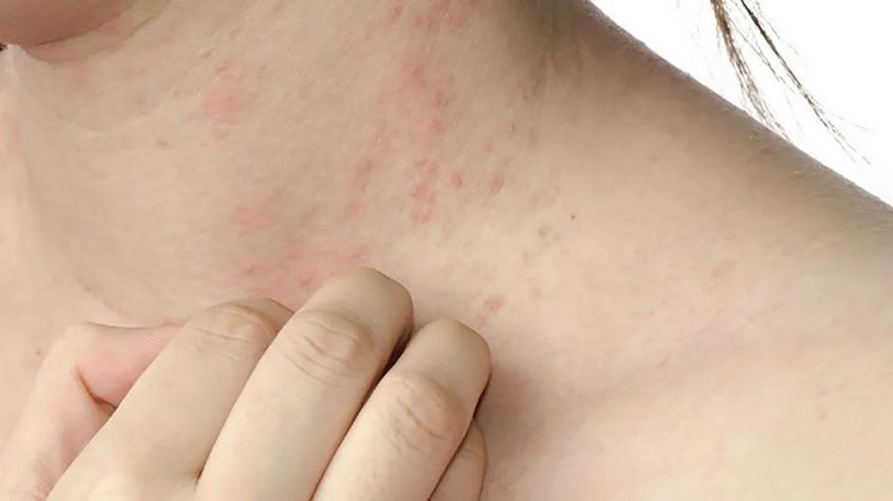Actualmente, el Ministerio de Salud evalúa la incorporación de tres tecnologías para el tratamiento de la dermatitis atópica en la Ley Ricarte Soto, lo que podría significar un avance importante en la reducción del gasto en el bolsillo. 