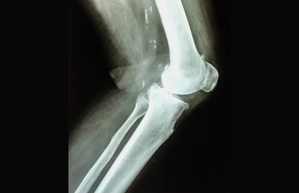 Buscando una alternativa para la rehabilitación postoperatoria de la artrosis de rodilla, el académico de la Facultad de Medicina, Hachi Manzur creó una rodillera electrónica.