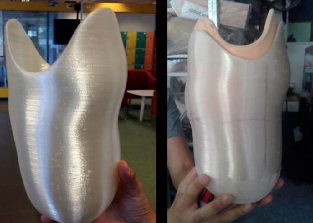 Hasta el momento 20 personas se han beneficiado por estas prótesis, gracias a un trabajo conjunto con el INRPAC.