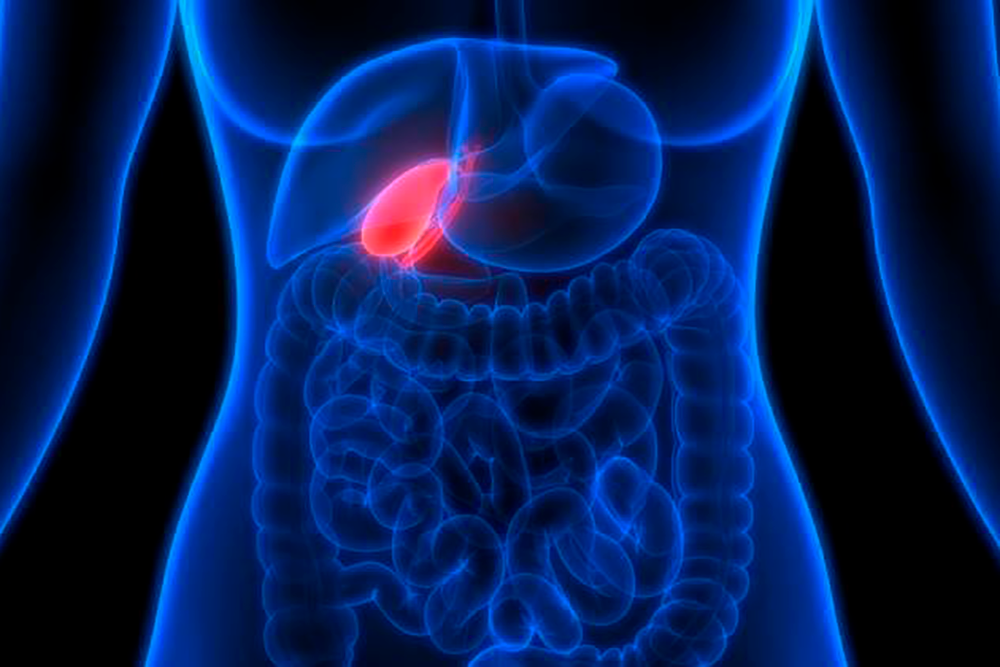 El cáncer de vesícula biliar generalmente es diagnosticado en etapas avanzadas, por cuanto se desarrolla en forma imperceptible, sin evidenciar síntomas en estadios más tempranos.