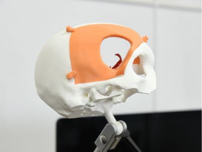 Esta es una muestra de la impresión 3D para una craneoplastía, creada en el Neurolab 3D