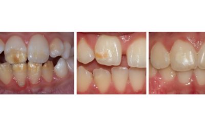 La HIM es una patología que afecta la calidad del esmalte dental de incisivos y molares, haciéndolo más susceptibles a la erosión y al desarrollo de caries.