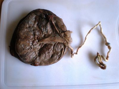 La Dra. Bosco explicó que la placenta funciona como un filtro que limpia el flujo sanguíneo que va de la madre al feto.